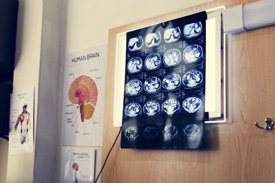 Recognizing Risk Factors of Alzheimer's Disease Development - Senior Solutions Management Group